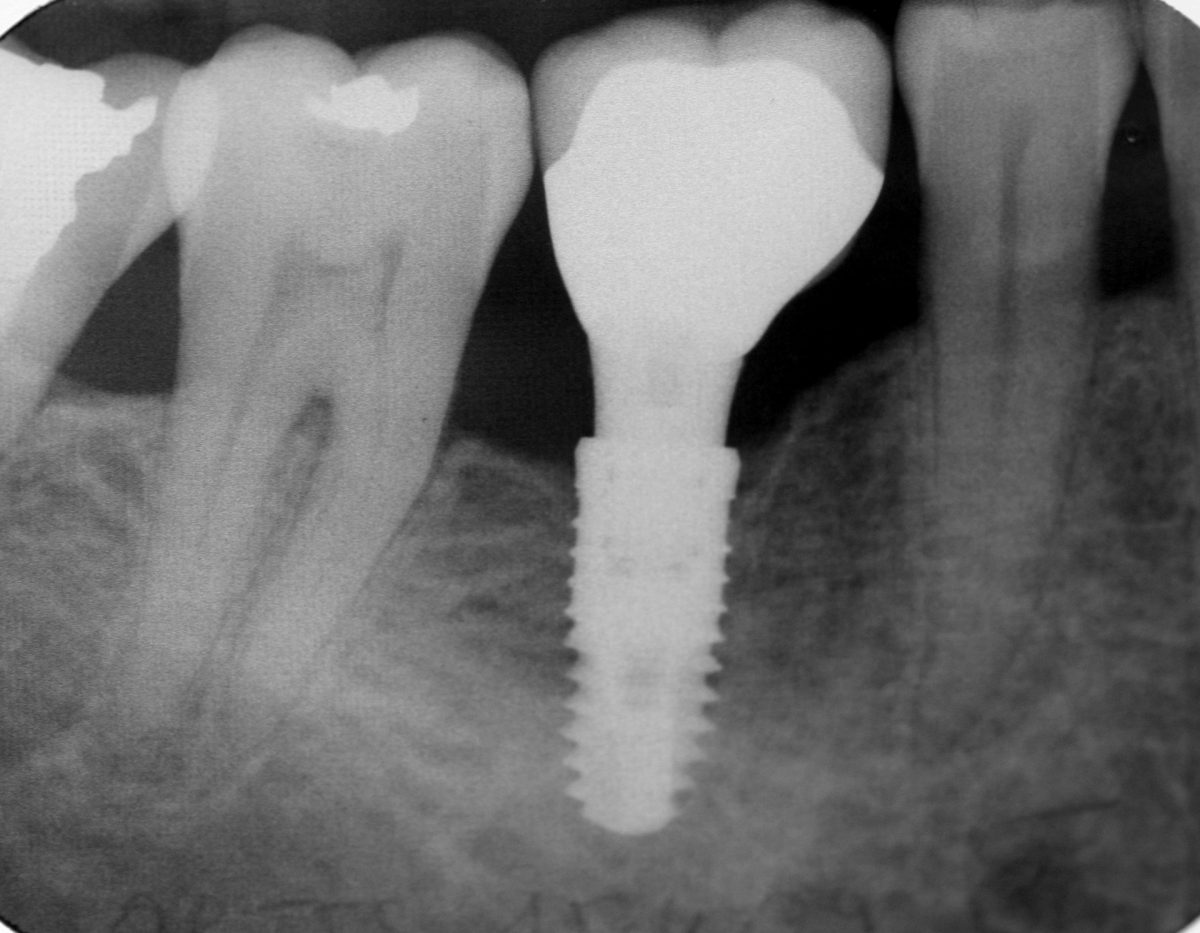 ‘Facing up’ to the reality of tooth loss